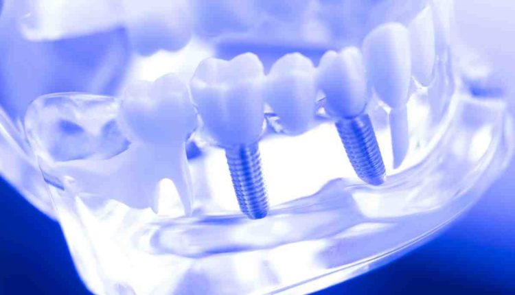 How much does lower teeth dental implants cost