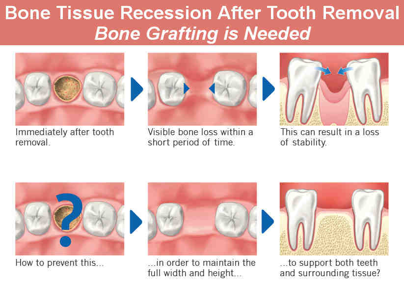 How much does surgery for gum recession cost?