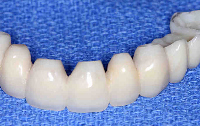 How much is a custom abutment?