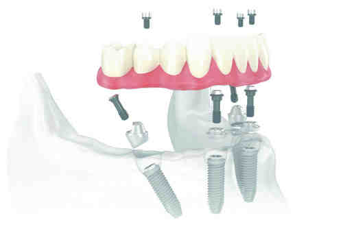 How much is a dental implant?