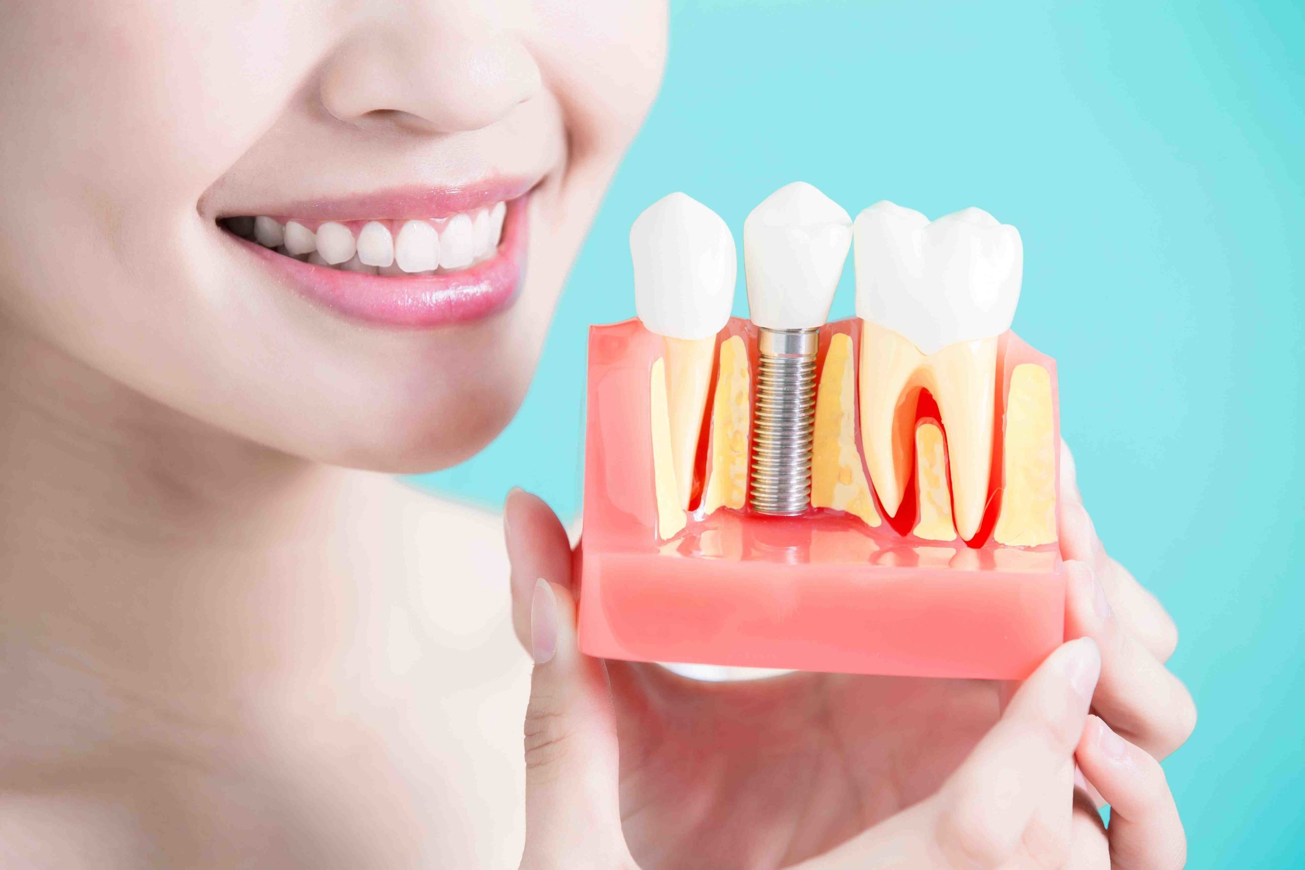 How much is a dental implant?