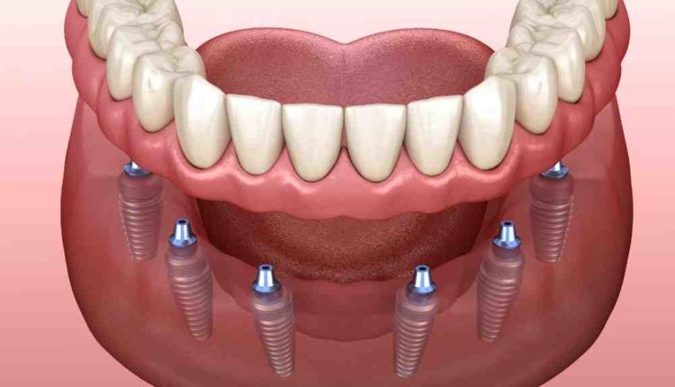 How much is a dental implant for 1 tooth