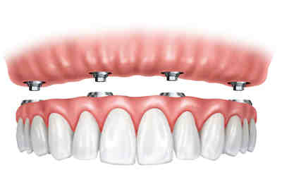 How much is a dental implant for one tooth in Michigan?