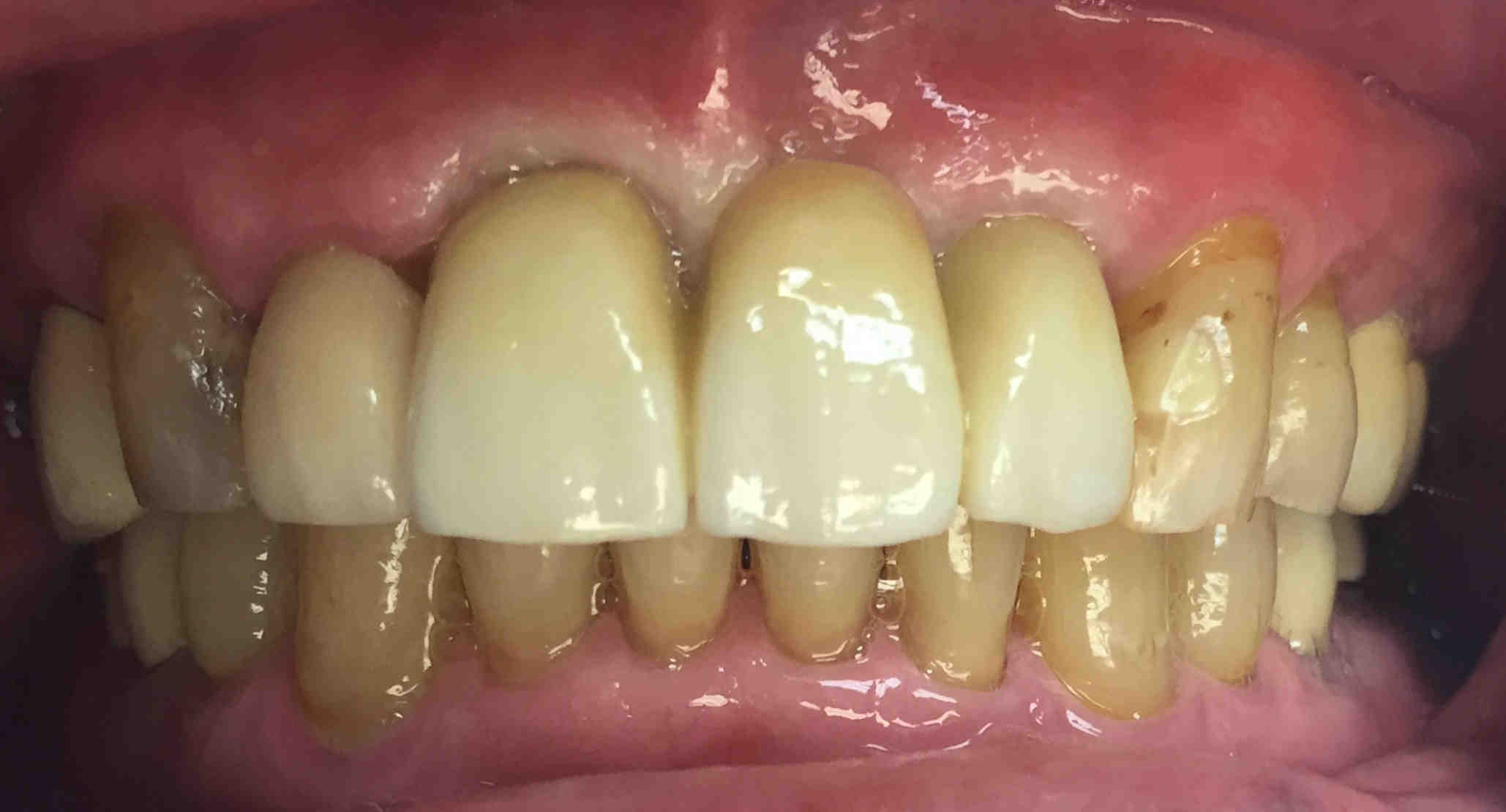How much is an implant in Mexico?