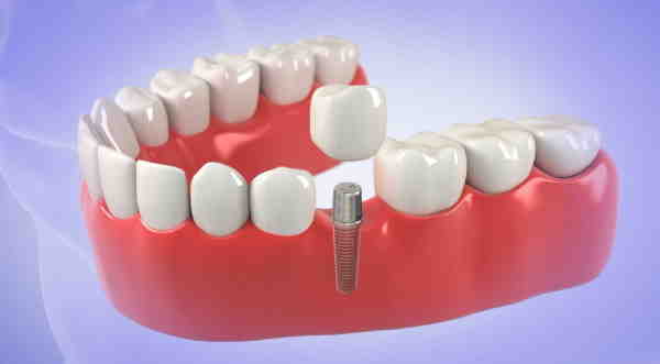 How much is the cheapest set of dental implants?