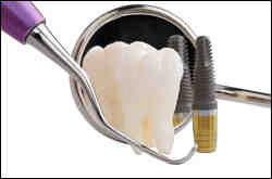 How much is the cheapest set of dental implants?