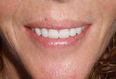 How much is the cheapest set of dental implants?