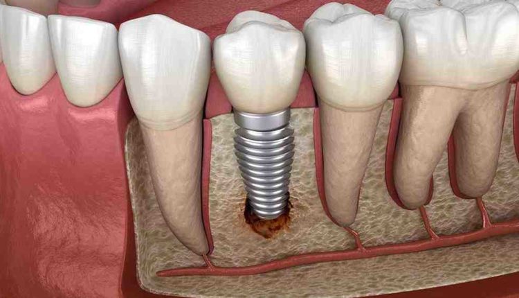 How much is the cost of a full set of dental implants?