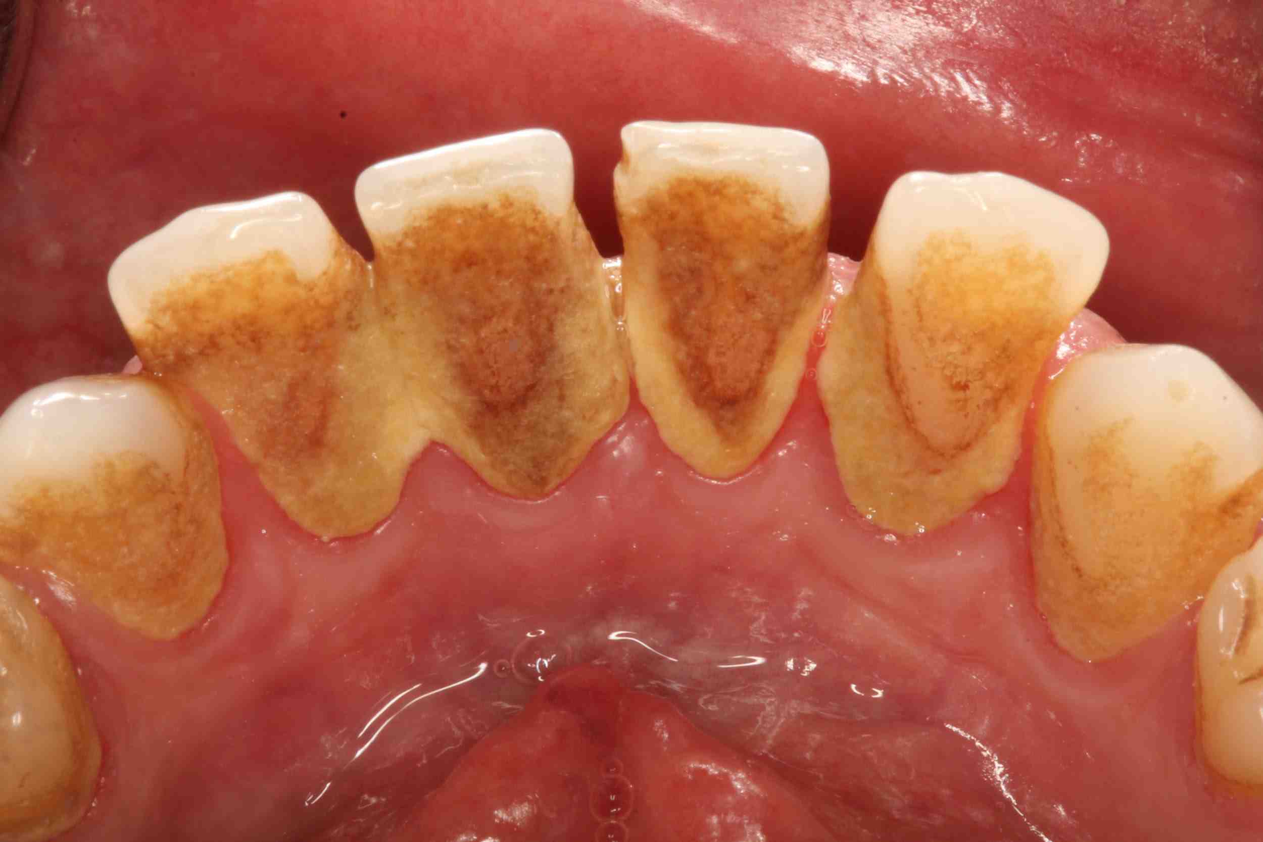 How often should dental implants be checked?