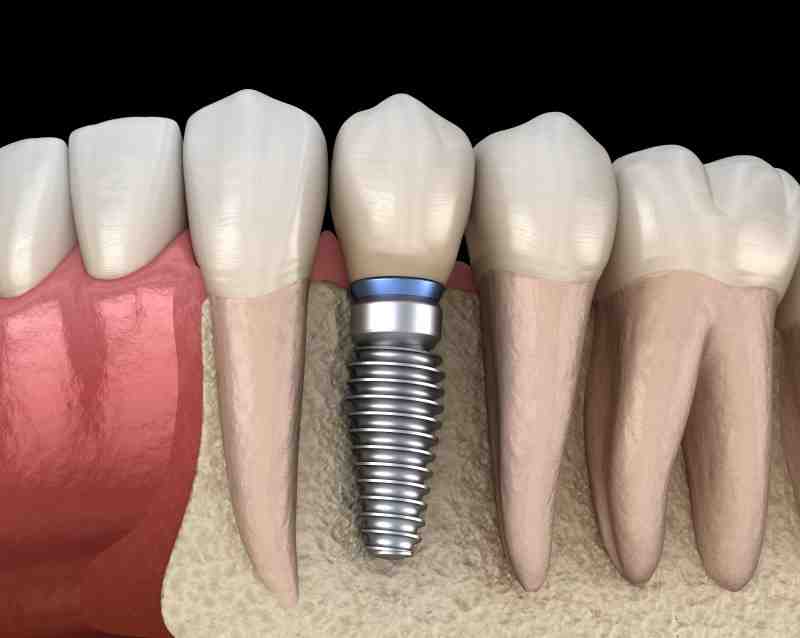 How painful is a bone graft for dental implant?