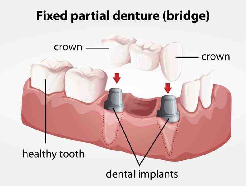 How painful is a tooth implant after surgery?