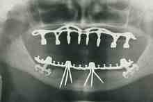 How should I sleep after dental implant?