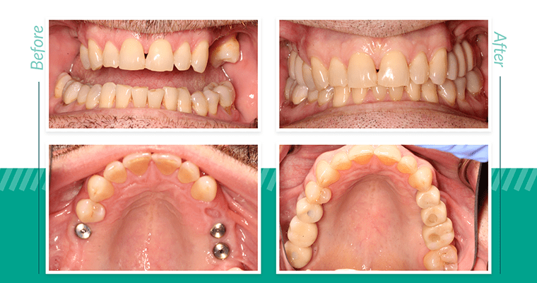 How small can a tooth implant be?