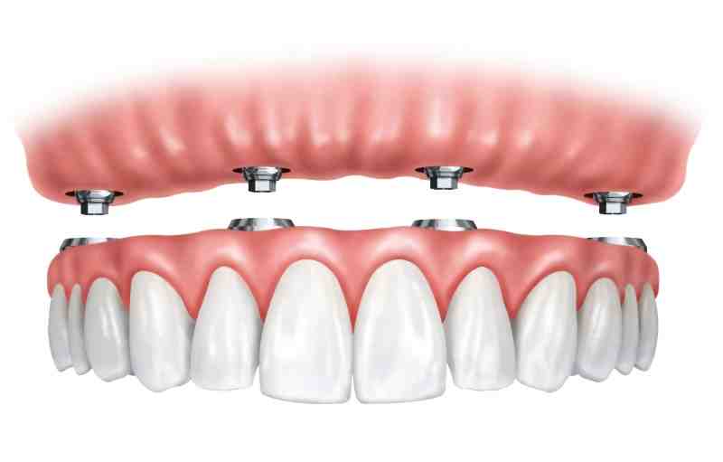 How soon after tooth extraction can I have an implant?