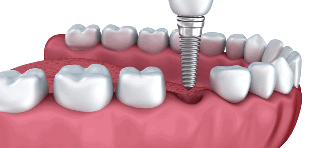 How soon after tooth extraction can you have an implant?