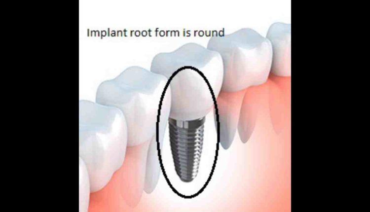 How to floss dental implant
