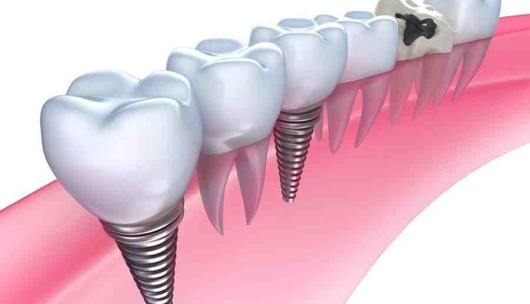 How to pay for dental implant