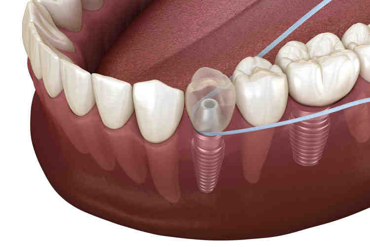 How you know if you have nerve damage from an implant?