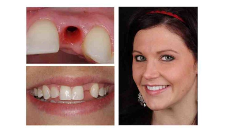 I have crooked and missed teeth how much is dental implants?