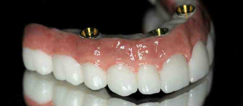 Is 70 too old for dental implants?