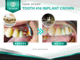 Is 70 too old for dental implants?