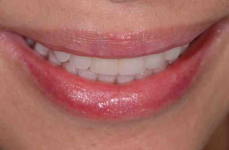 Is Listerine safe for dentures?