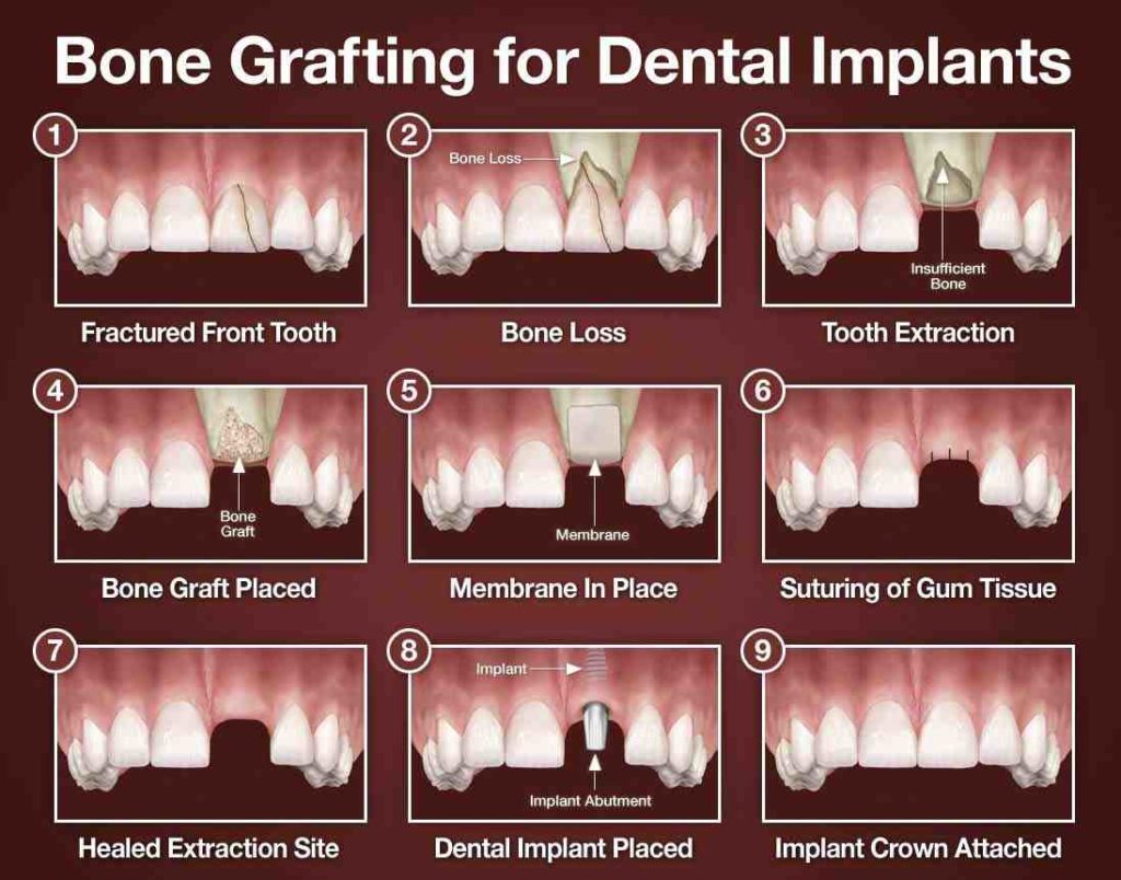 is-a-bone-graft-needed-after-extraction-if-dental-implant-is-placed