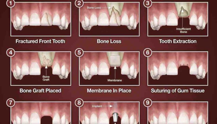 Is a bone graft needed after extraction if dental implant is placed immediately