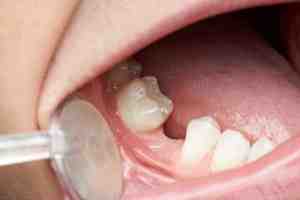 Is a dental bone graft necessary?