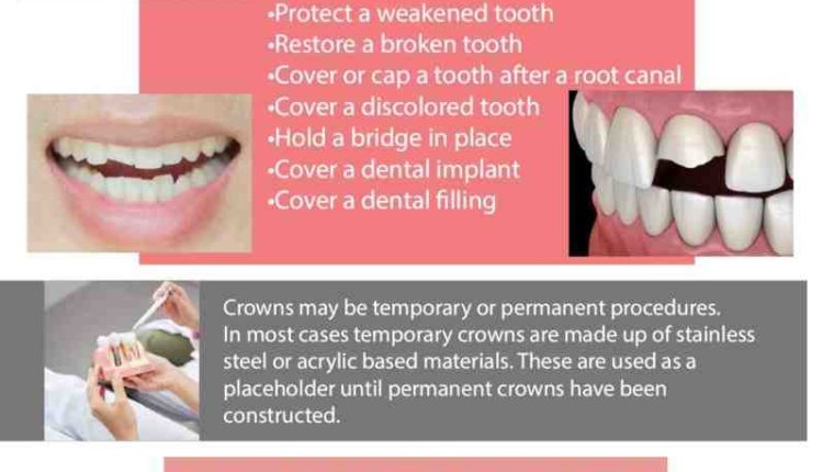 Is A Dental Implant Better Than Root Canal With A Crown - Dental News 