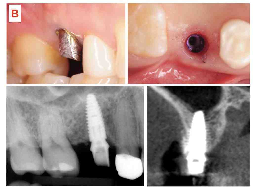 Is a dental implant falling out an emergency?