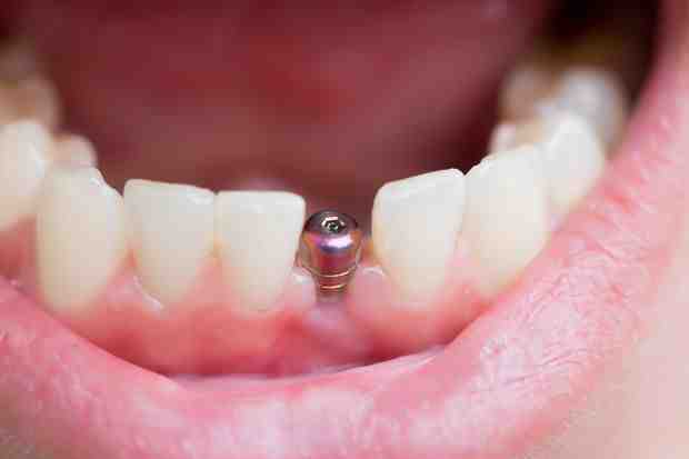Is a dental implants more painful than a root canal?