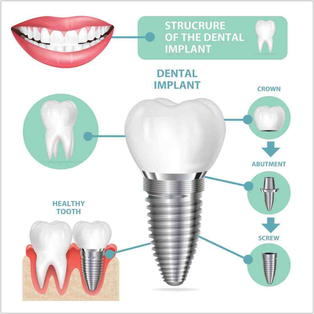 What causes dental implants to loosen - Dental News Network