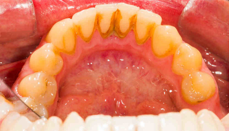 Is a major factor in determining long-term prognosis of the dental implant. quizlet
