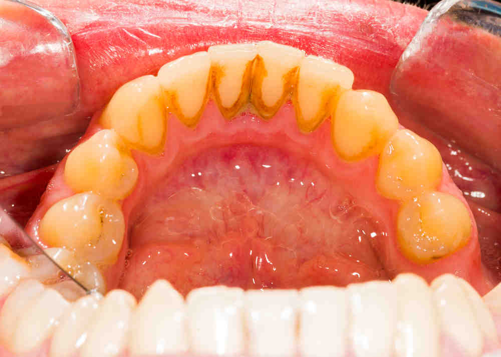 Is A Major Factor In Determining Long term Prognosis Of The Dental 