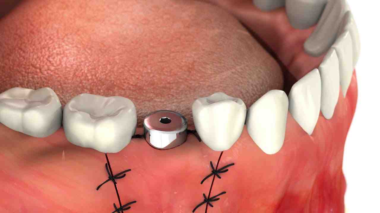 Is abutment surgery painful?