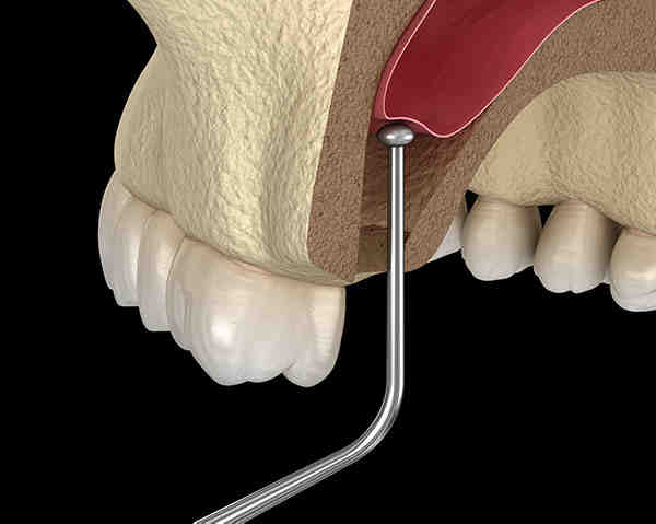 Is bone grafting painful?