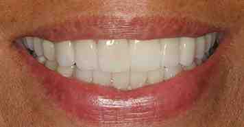 Is dental implant a surgical procedure?