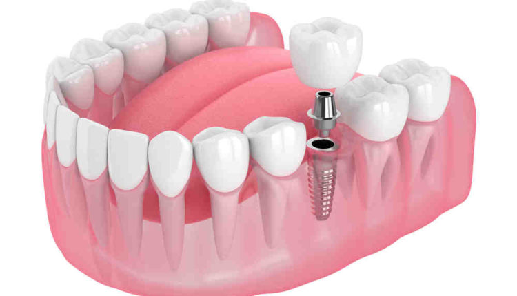 Is dental implant considered oral surgery by insurance
