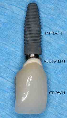 Is dentures better than implants?