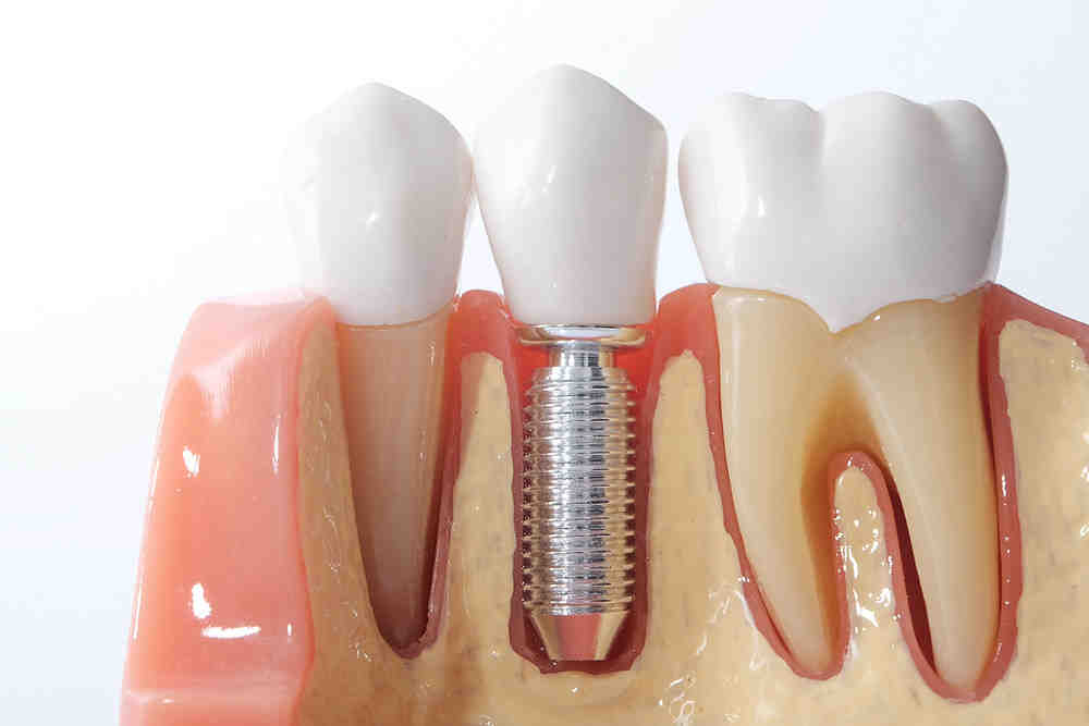 Is having dental implants painful?