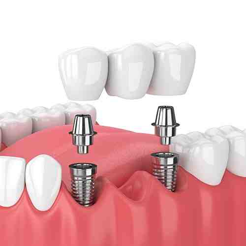 Is it OK not to replace a missing tooth?