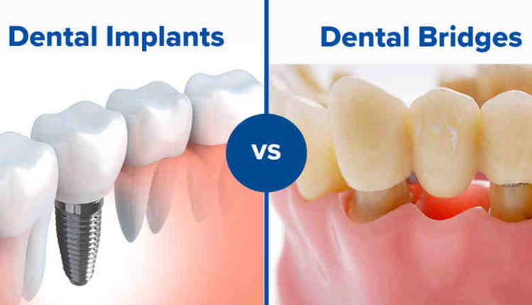 Is it a good choice to get dental implants