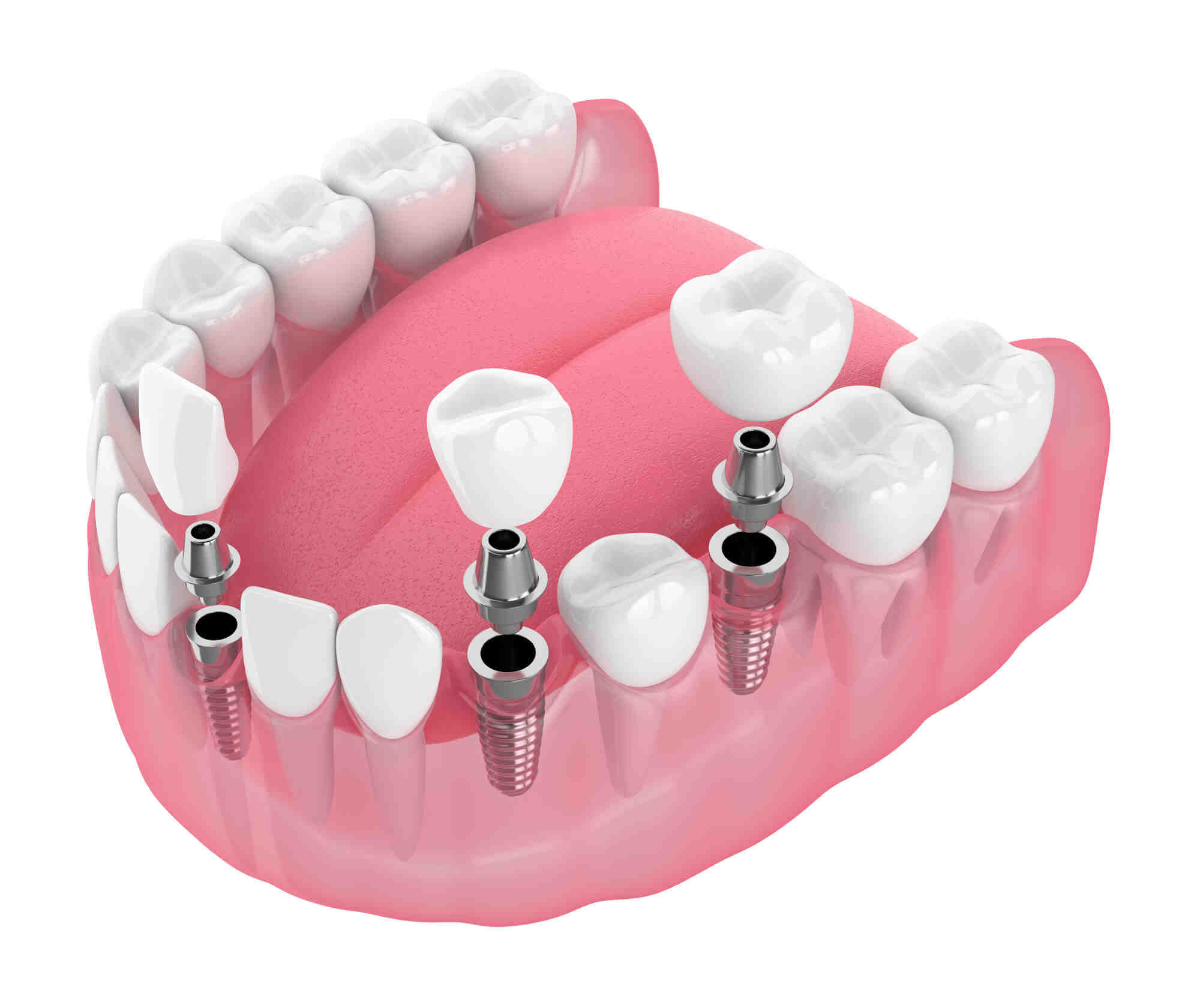 Is it better to get a bridge or implant?