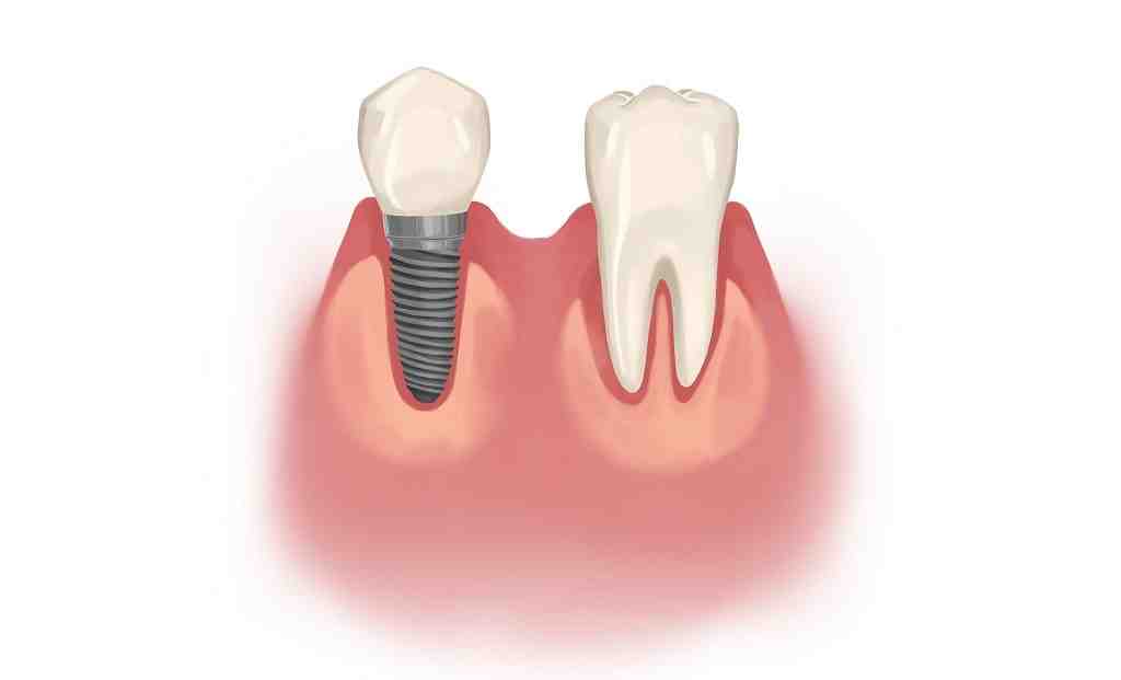 Is it better to get a bridge or implant?