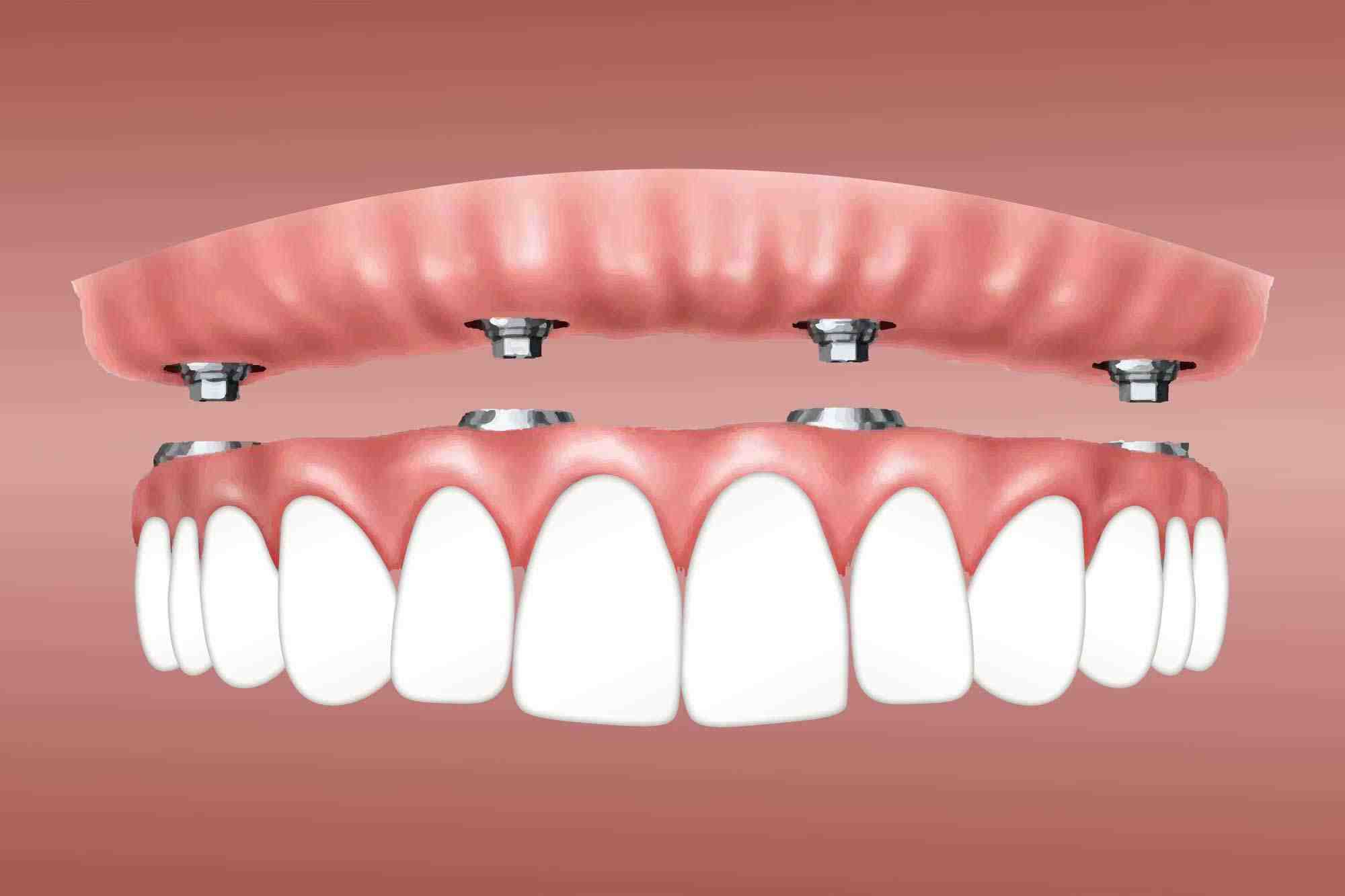 Is it better to get a bridge or implant?