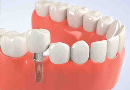 Is it better to get a bridge or implant?