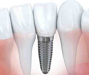 Is it better to get a bridge or implant?