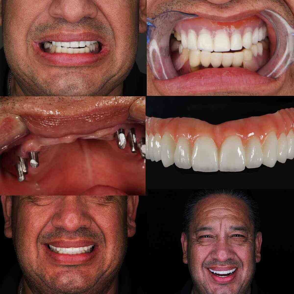 Is it better to get a bridge or implant?