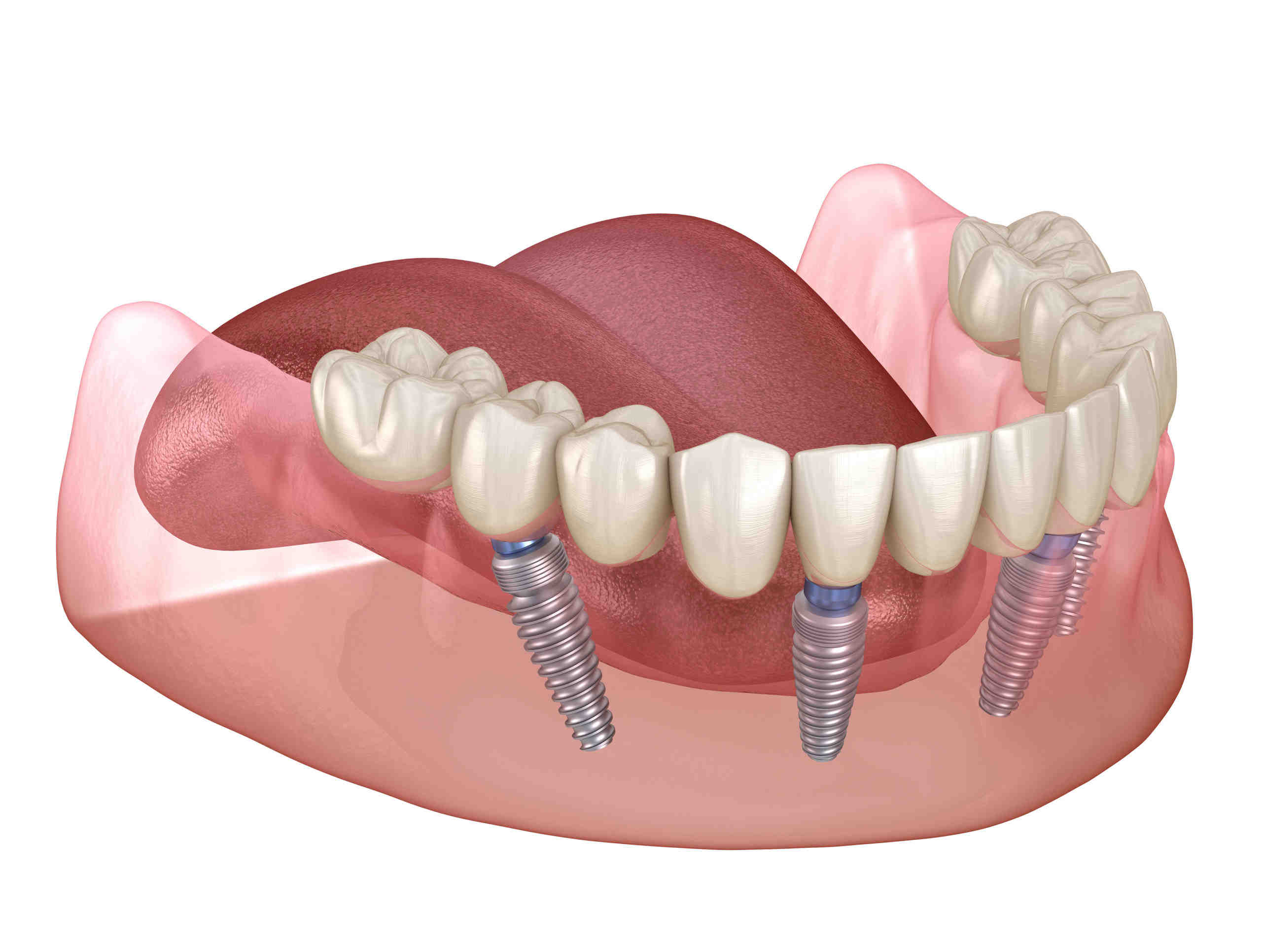 which-of-the-following-is-the-minimum-number-of-years-a-dental-implant